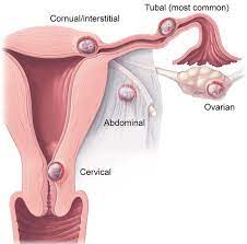 Diagram showing locations of pregnancies: fallopian tube, ovaries, abdominal cavity