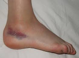 Sprains: Purple Discoloration to Ankle, Signaling Possible Injury
