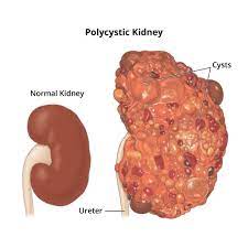 Comparison of Normal Kidney and Polycystic Kidney: Understanding Kidney Failure
