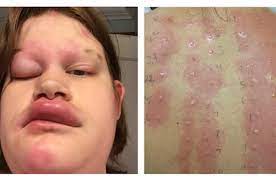 Female displaying allergic reaction with swollen lips and eye and rash: emergency signs