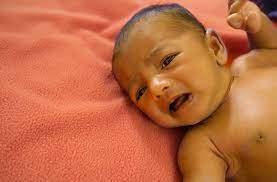 Image of a jaundiced newborn baby experiencing Neonatal jaundice