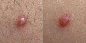 Image of skin lesions, a possible symptom of vaginal infection