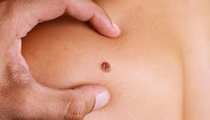 Mole on skin - Monitoring for signs of skin cancer