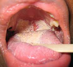 Person showing oral thrush symptoms with white patches on tongue and inner cheeks