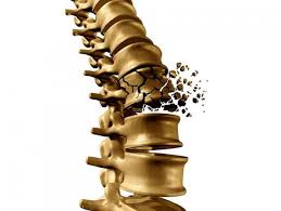 Close-up image showing a fractured spine