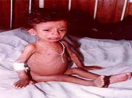 Dehydrated child sitting in a cot, showing symptoms of dehydration.