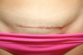 Healed cesarean scar on lower abdomen 