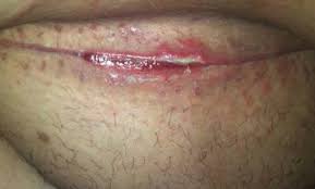 unhealed surgical scar on lower abdomen - wound care