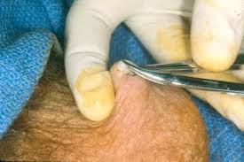 Vasectomy procedure being performed by a medical professional