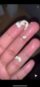 Image of whitish substance on hands, possibly indicating vaginal infection