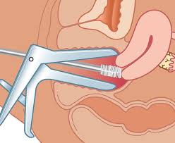 Pap smear procedure: Speculum exposing cervix, cervical brush collecting specimen: cervical cancer screening