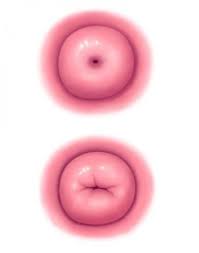 The normal appearance of the cervix in a nulliparous and a multiparous woman
