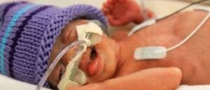 Image of a jaundiced newborn with a nasogastric tube