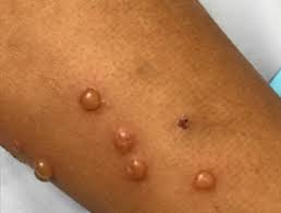 Watery bumps on the skin - Insect bites and stings