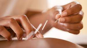 Closeup of Acupuncture Needles - Traditional Chinese medicine practice for holistic healing and wellness.