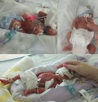 Neonatal care team with world-record surviving premature triplets.