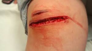 Deep lacerations on an arm - wound care