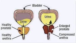 Diagram illustrating the impact of normal vs. enlarged prostate on bladder function
