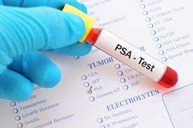 Test tube containing PSA sample for prostate cancer screening