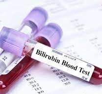 Blood sample being drawn to test bilirubin levels for diagnosing neonatal jaundice