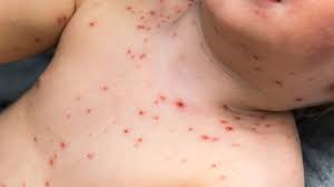 Child with chicken pox rash on the thorax