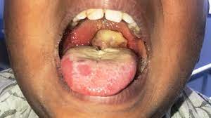 Child with diphtheria ulcers in the back of the mouth from a lack of immunization