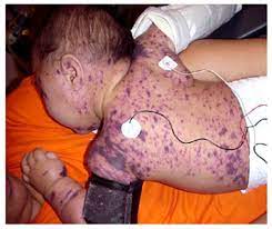Child with generalized purple rash over the body, characteristic of septicemia: consequences of no immunization