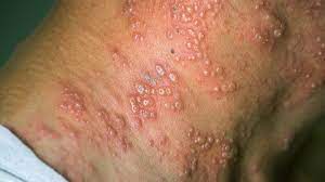 contagious rash caused by the varicella-zoster virus: consequences of no immunization