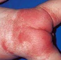 Close-up of a rash on a baby’s bottom, with inflamed and red skin.