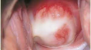 Image of inflamed cervix with copious white discharge, indicative of potential infection
