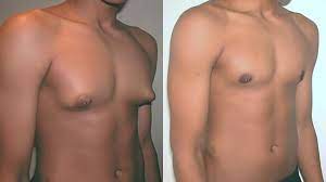 enlargement of the male breast tissue