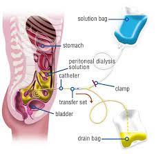 Peritoneal Dialysis Setup: Catheter and Dialysis Fluid Bags