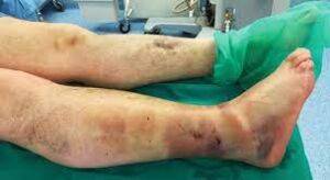 Leg showing signs of compartment syndrome