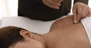 Person applying Acupuncture Needles - Traditional Chinese medicine practitioner administering holistic healing treatment.