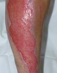 Severe burn on foot - extensive skin peeling and tissue damage