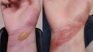 First and second degree burns on hand - superficial burn with redness and mild swelling