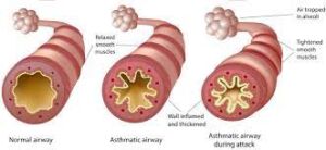Pathophysiology of the lungs during an asthma attack: airway inflammation and bronchoconstriction