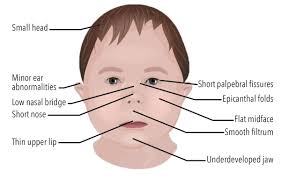 Child displaying fetal alcohol syndrome"