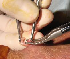 Vasectomy procedure being performed on a man