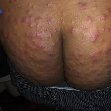 Person with generalized rash over the buttocks