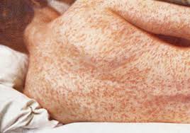 Person with generalized rash over the body from lack of immunization