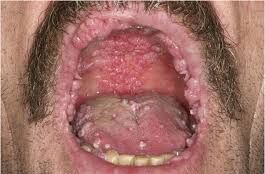 Person with generalized oral lesions indicative of HPV infection