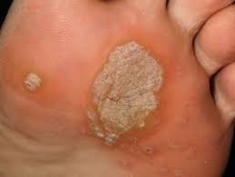 Plantar wart on the foot