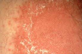 Close-up of irritated skin