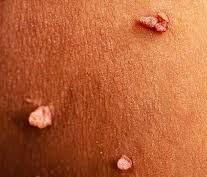Image of warts on the skin