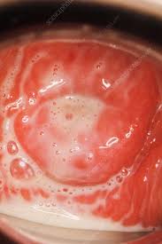 Image of cervix covered by yellowish discharge