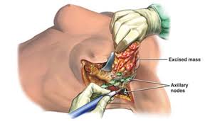  a surgical procedure that is used to remove lymph nodes in the axilla