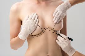 Person receiving skin marking for breast reconstruction surgery