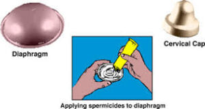Assorted contraceptives barrier methods: condoms, diaphragms, and spermicides
