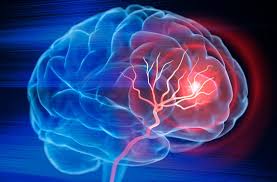 Strokes: Medical image portraying a stroke in the brain, underlining the importance of early detection.